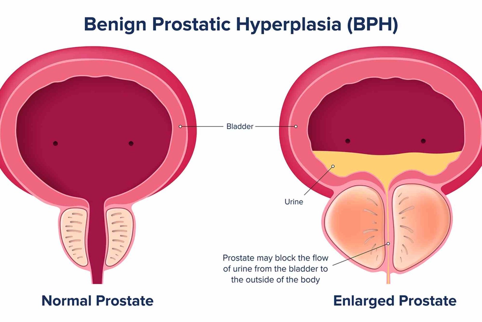 What Lifestyle Changes Are Included in Bph Management Guidelines: Symptoms, Treatment & Prevention